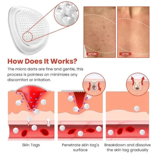 DermaSmooth Skin Tag Remover Patch box and adhesive patch sheets