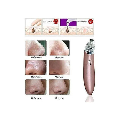 5in1 Blackhead Vacuum Acne Cleaner – Pore Cleanser & Skin Care Tool khubsurti.pk